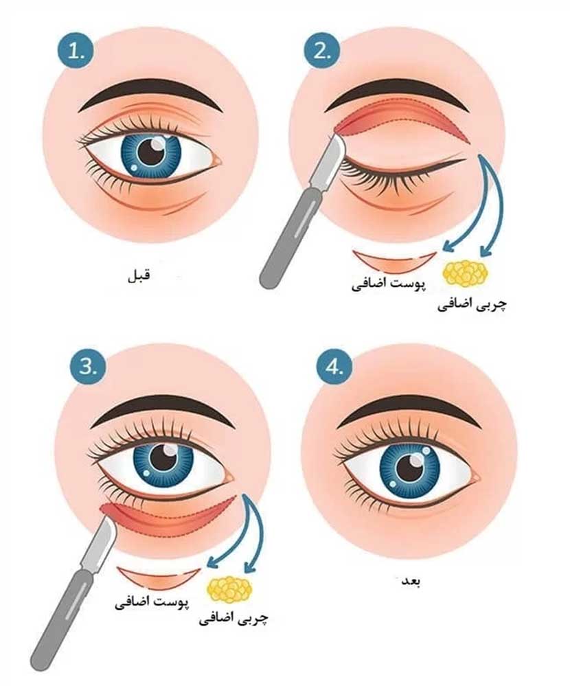 جراحی بلفاروپلاستی در شاهین شهر
