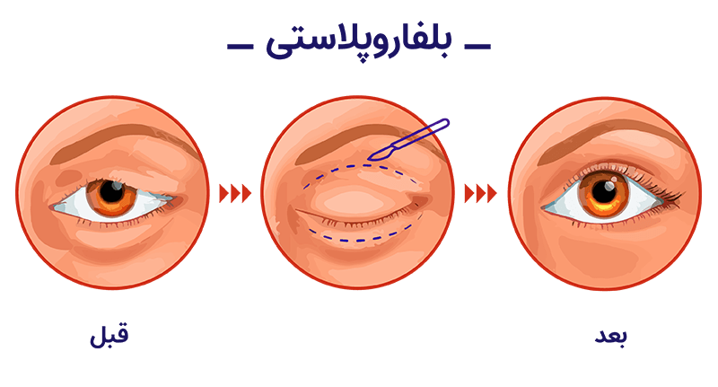 جراحی بلفاروپلاستی در شاهین شهر