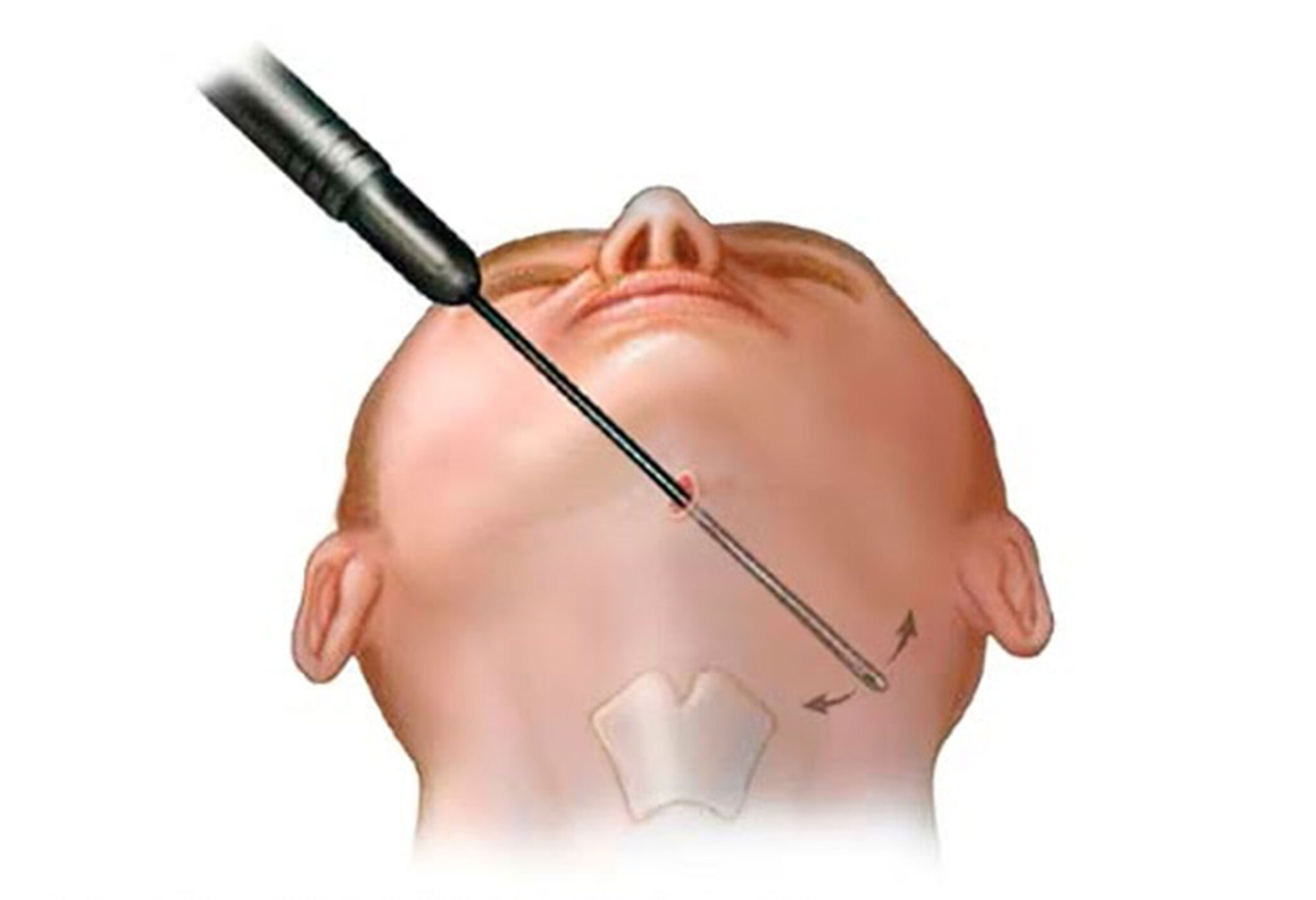 جراحی رفع غبغب در شاهین شهر