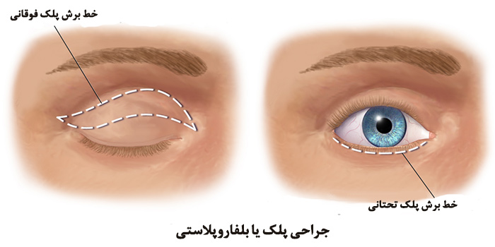 جراحی بلفاروپلاستی در شاهین شهر