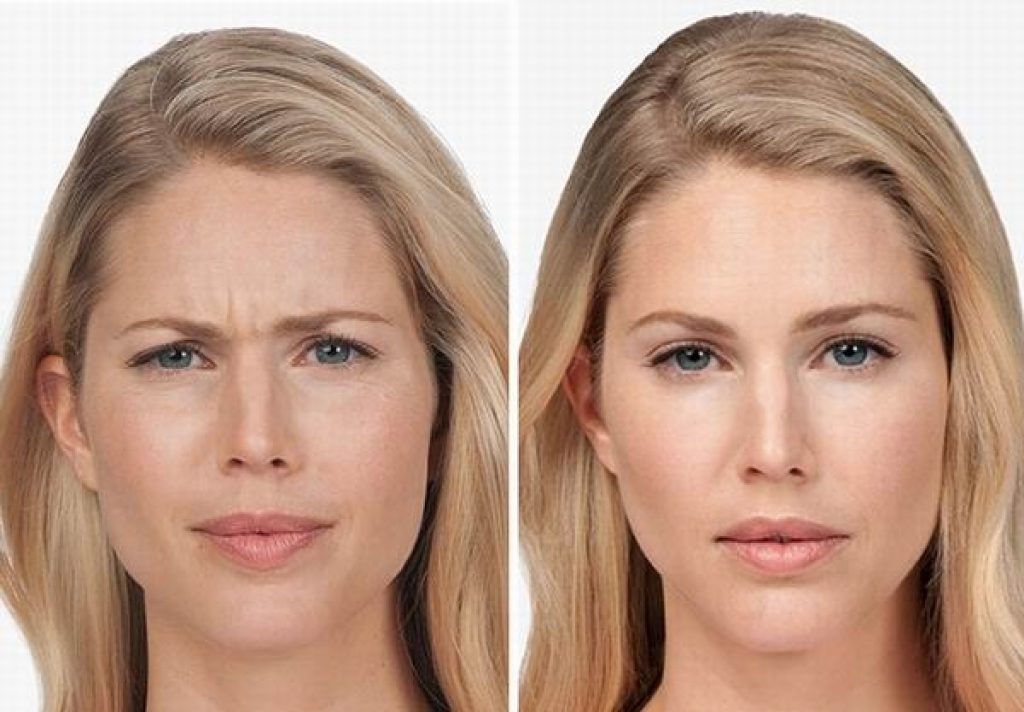 تزریق بوتاکس در شاهین شهر