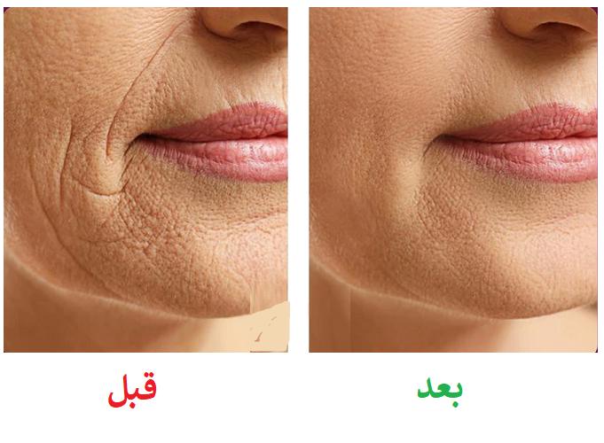 هایفوتراپی در شاهین شهر