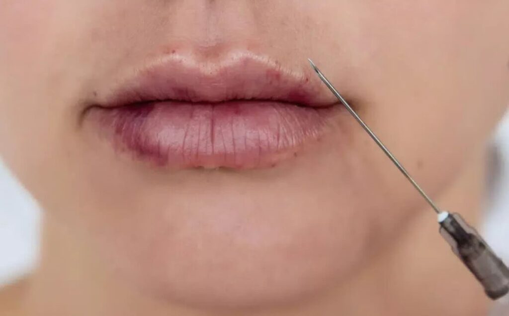 تزریق ژل لب در شاهین شهر