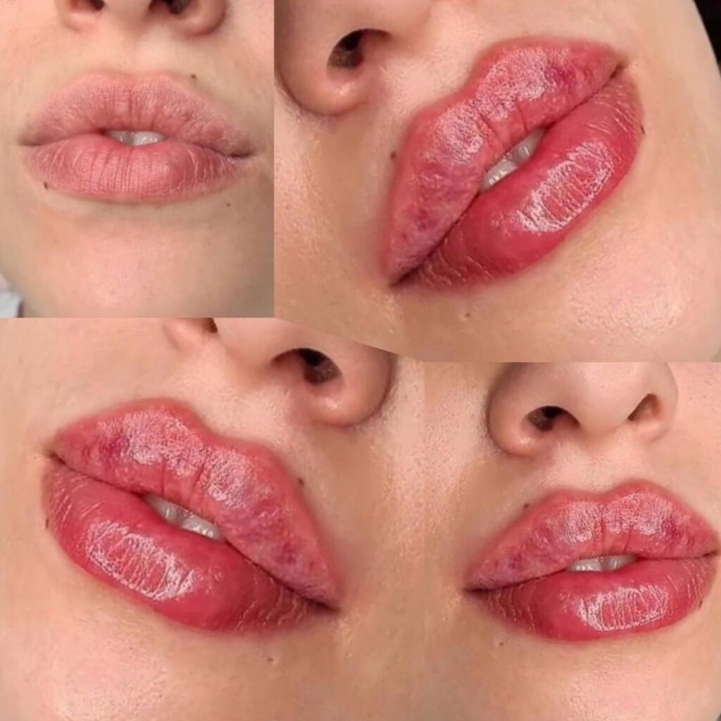 تزریق ژل لب در شاهین شهر
