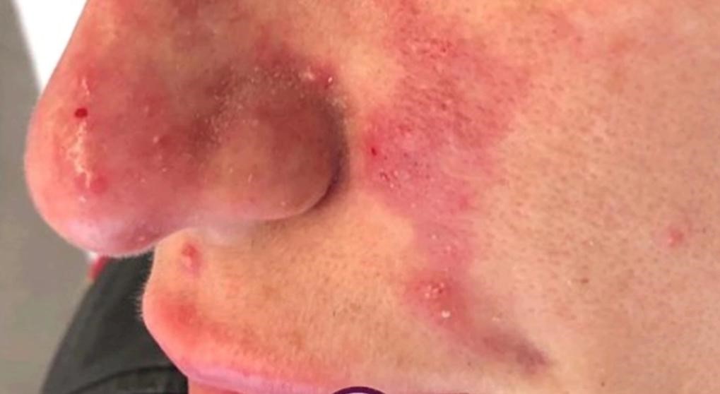 علائم پاره شدن نخ لیفت صورت
