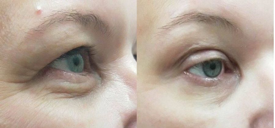 عوارض هایفوتراپی صورت