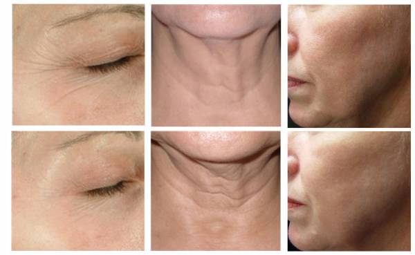 عوارض هایفوتراپی صورت