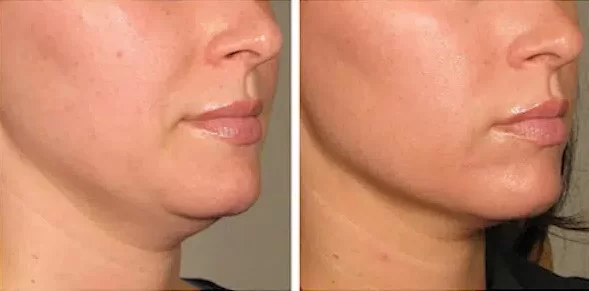 هایفوتراپی غبغب