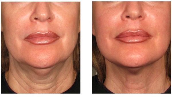 تاثیر هایفو بر صورت