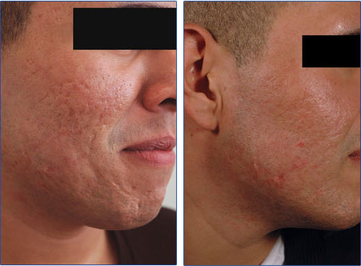 درمان جای جوش و التهاب آن