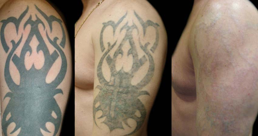 پاك كردن تاتو با ليزر در اصفهان