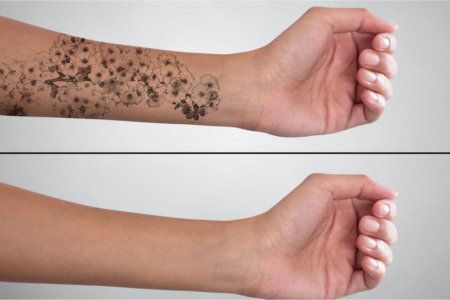 پاك كردن تاتو با ليزر در اصفهان