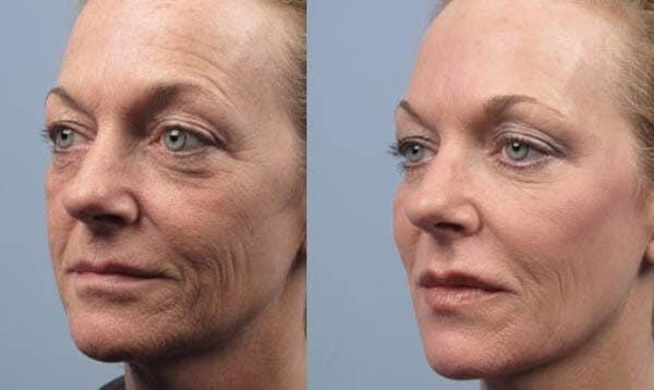 چند بار میتوان هایفو انجام داد