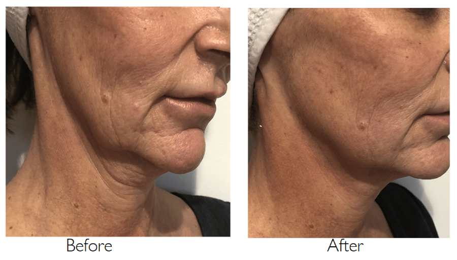 چند بار میتوان هایفو انجام داد