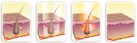 لیزر کل بدن چند جلسه است