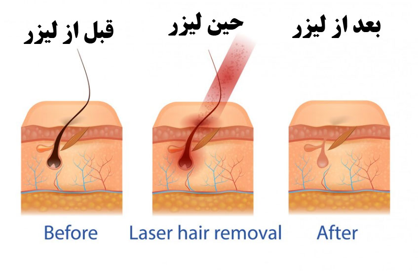 لیزر کل بدن چند جلسه است