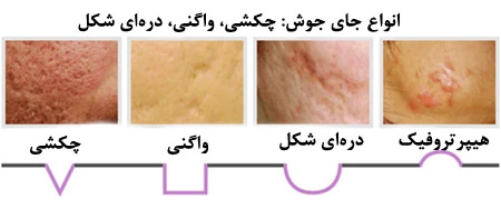 درمان جای جوش در اصفهان
