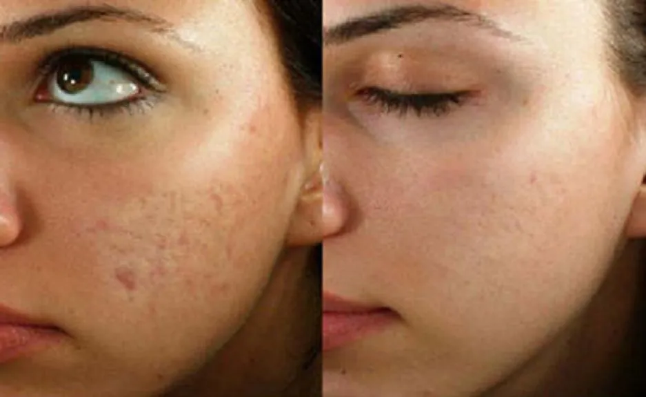 درمان جای جوش در اصفهان