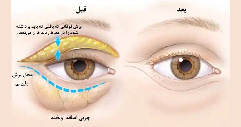 بلفاروپلاستی پلک بالا در اصفهان