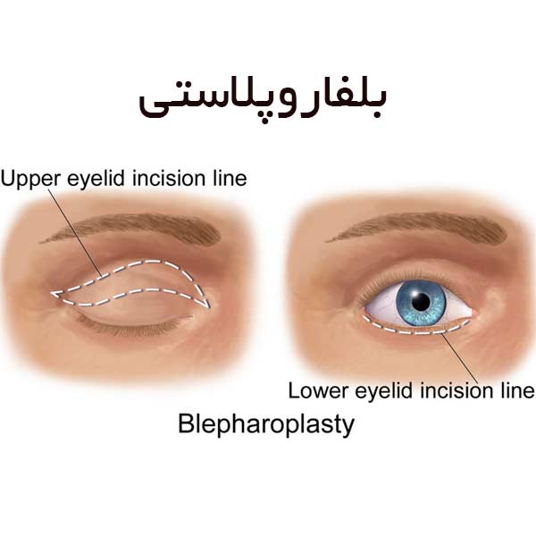 بلفاروپلاستی پلک بالا در اصفهان