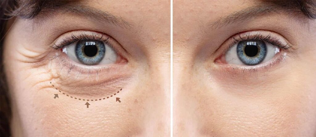 بلفاروپلاستی پلک پایین در اصفهان