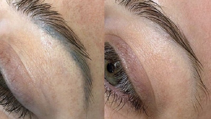 دكتر خوب براي پاك كردن تاتو در اصفهان