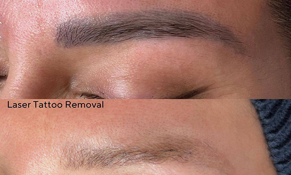 دكتر خوب براي پاك كردن تاتو در اصفهان