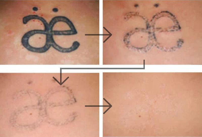 دكتر خوب براي پاك كردن تاتو در اصفهان