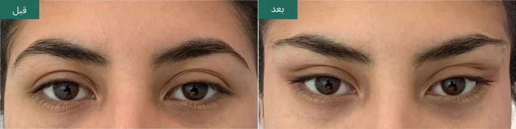 بوتاکس چشم گربه ای در اصفهان