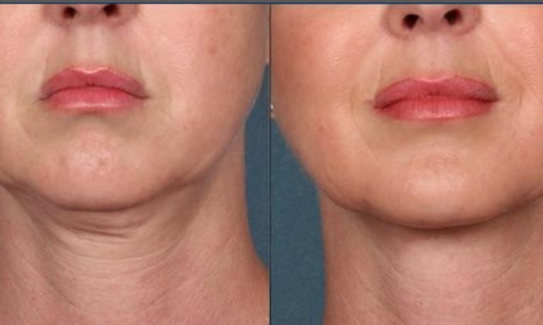 هایفوتراپی برای لاغری صورت