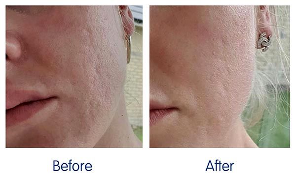 هایفوتراپی برای درمان جای جوش