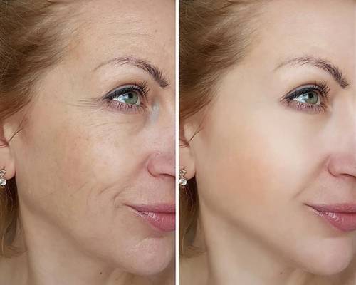 هایفوتراپی برای لاغری صورت