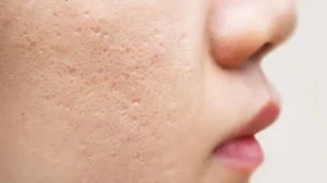 سریعترین روش از بین بردن جای جوش با دستگاه