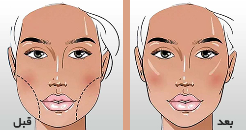 زاویه سازی صورت با نخ لیفت