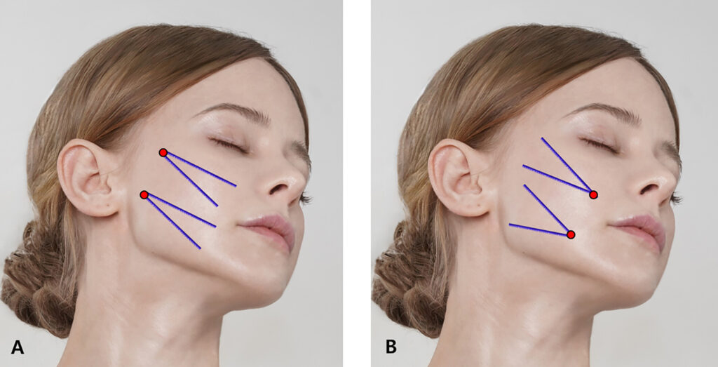 زاویه سازی صورت با نخ لیفت