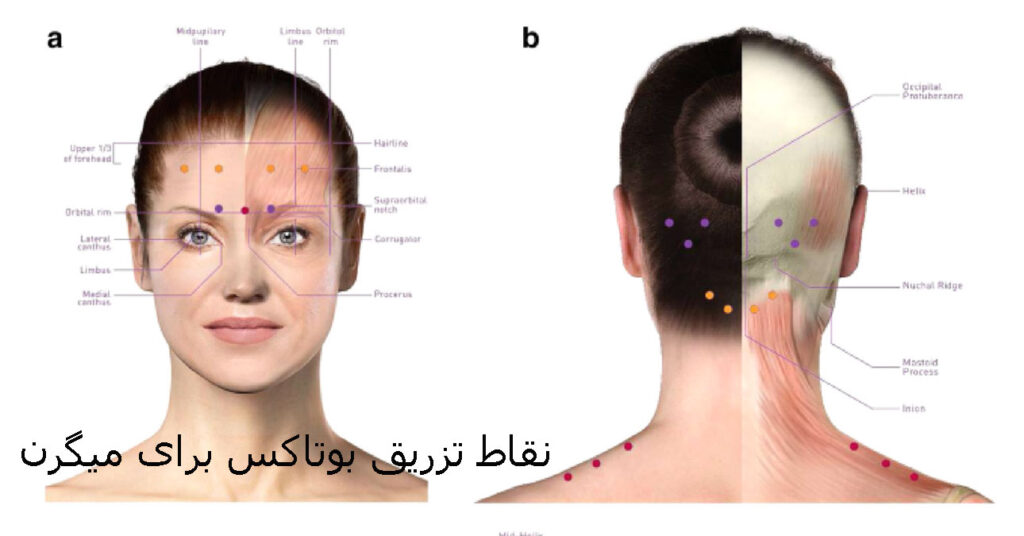 تزریق بوتاکس برای میگرن در اصفهان