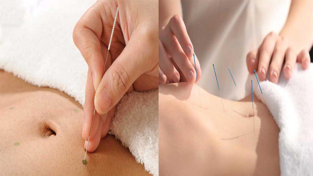 کاشت نخ لاغری در اصفهان