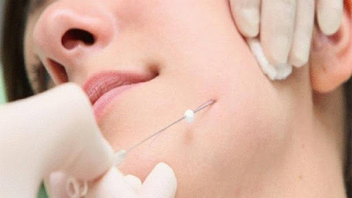 کاشت نخ لاغری در شاهین شهر