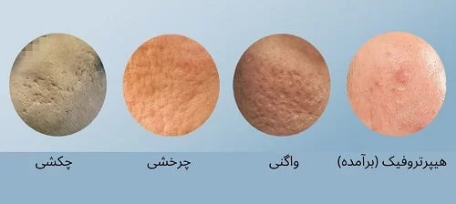 درمان لک ناشی از جای جوش 