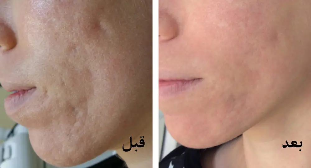 لیزر جای جوش چند جلسه طول میکشد؟