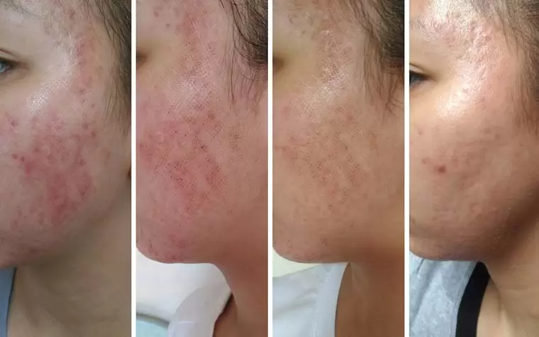 بهترین سن برای لیزر جای جوش