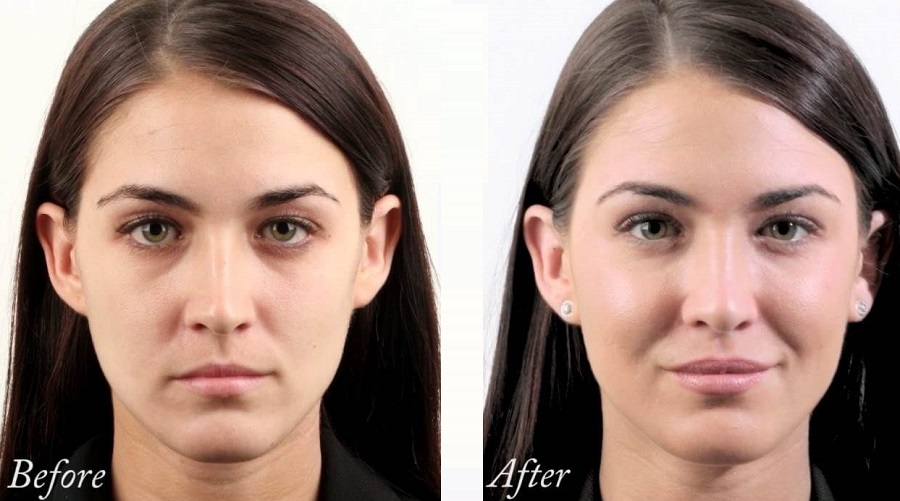 تزریق ژل گونه در اصفهان