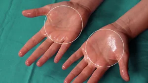 تزریق بوتاکس کف دست در اصفهان