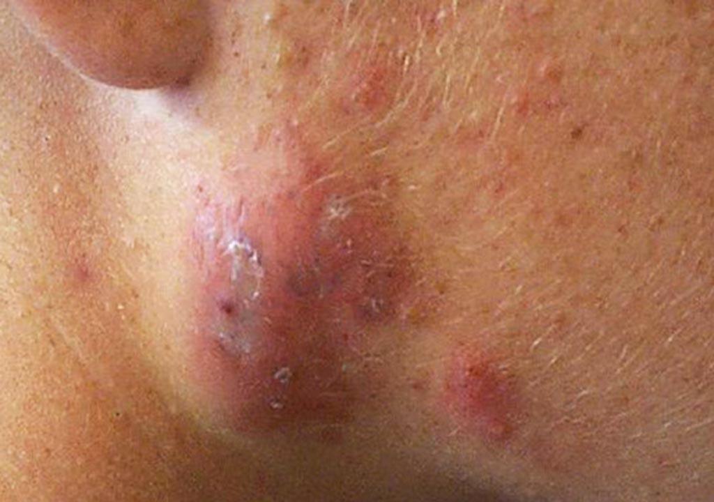 درمان جوش‌های کیستی