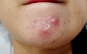 درمان جوش‌های کیستی