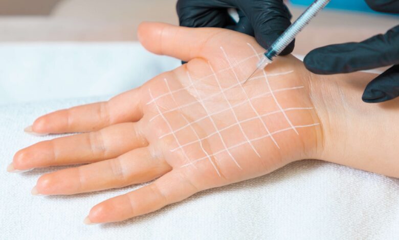 تزریق بوتاکس کف دست در اصفهان