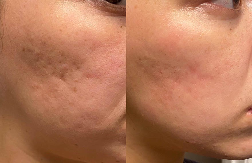 لیزر بهتر است یا میکرونیدلینگ؟