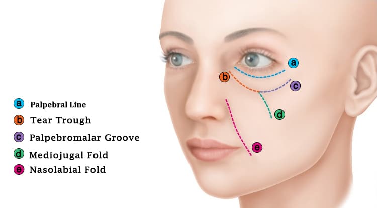 بهترین دکتر تزریق فیلر زیر چشم در اصفهان 