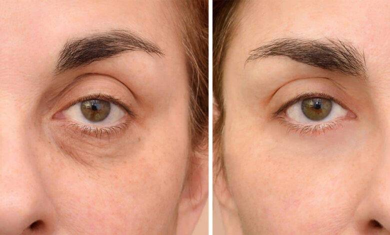 بهترین دکتر تزریق فیلر زیر چشم در اصفهان 