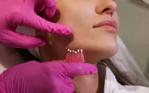 لیفت غبغب با نخ